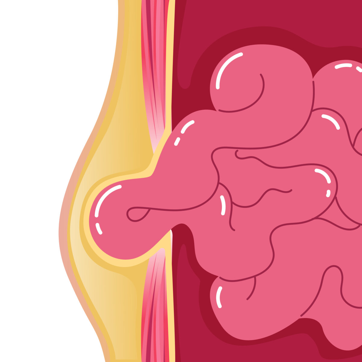 Hernia: Symptoms, Causes, Diagnosis & Prevention Guide